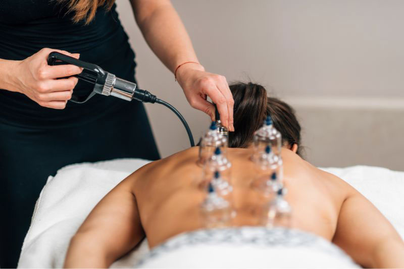 I benefici della coppettazione cinese: tra innovazione e antiche tradizioni